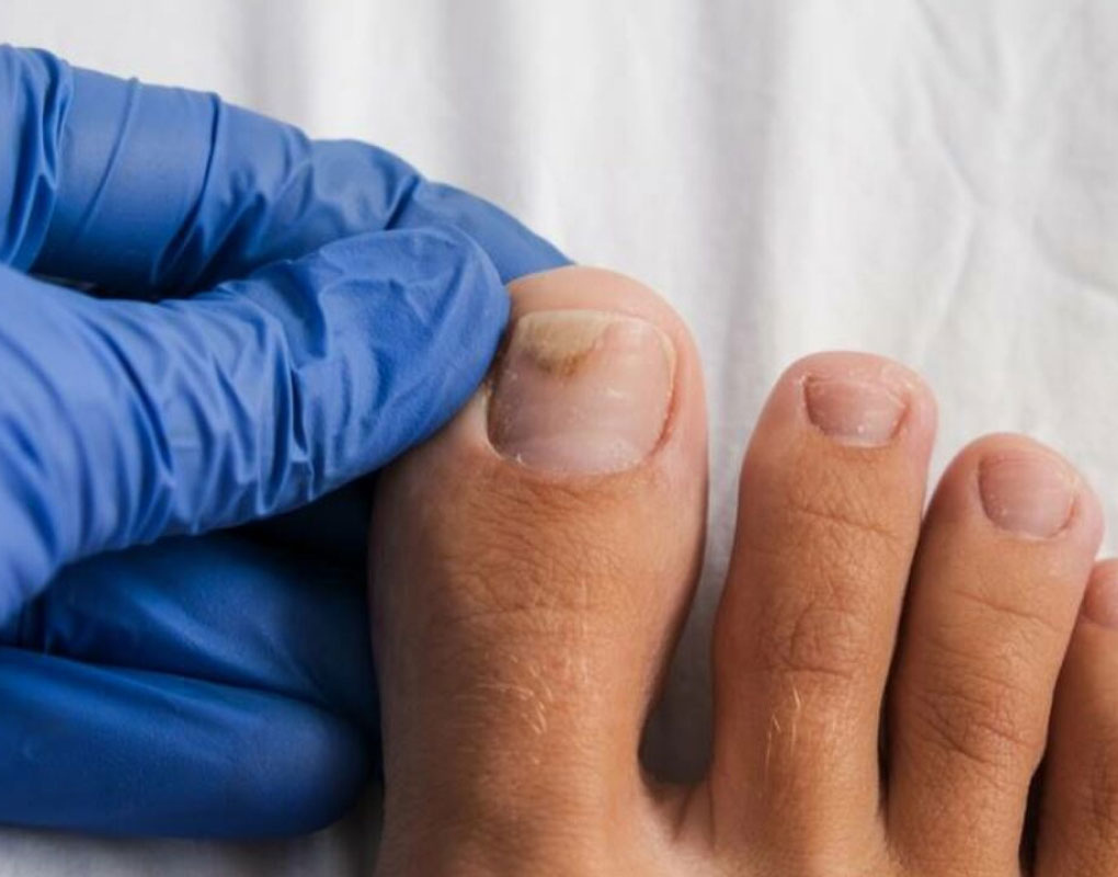 Black toenail after injury - ugly dark blood under nail on the foot of  caucasian person. Health problem with toe and finger. Stock Photo | Adobe  Stock