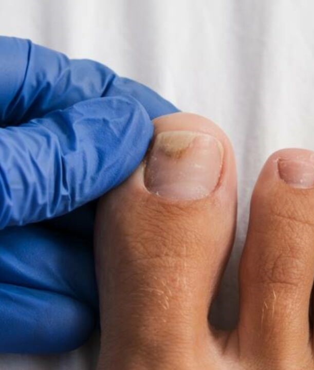 toenail2