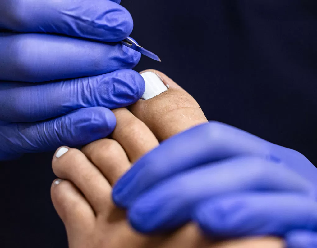 Ingrown Toenails common causes